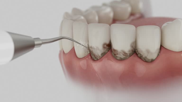 Trusted Wisdom Tooth Removal service in Bunker Hill, IL - Dentist Open Now